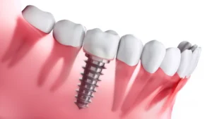 Dental-implant