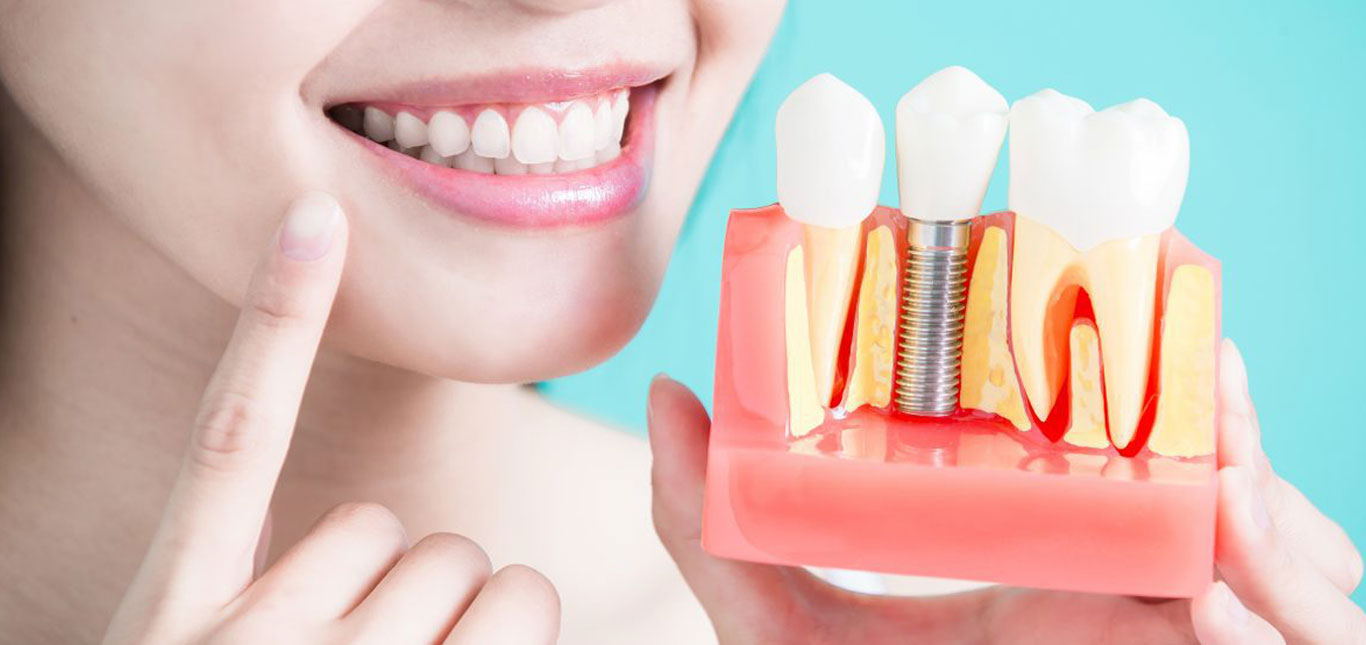 DENTAL IMPLANT