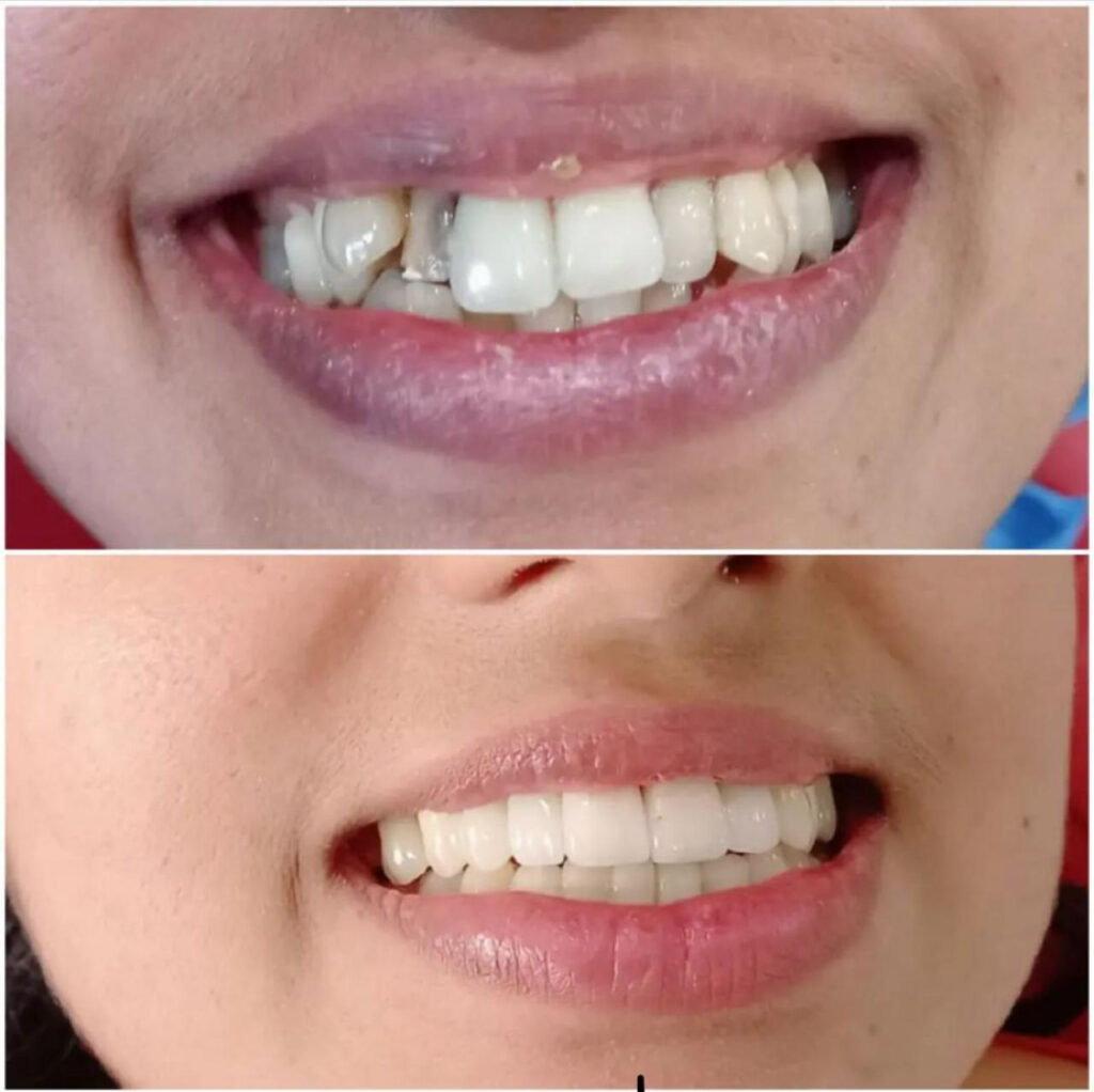 SMILE MAKEOVER