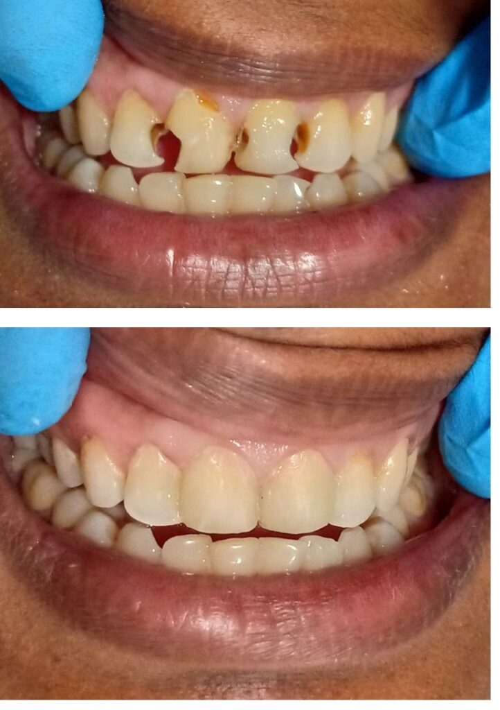 COMPOSITE VENEERING