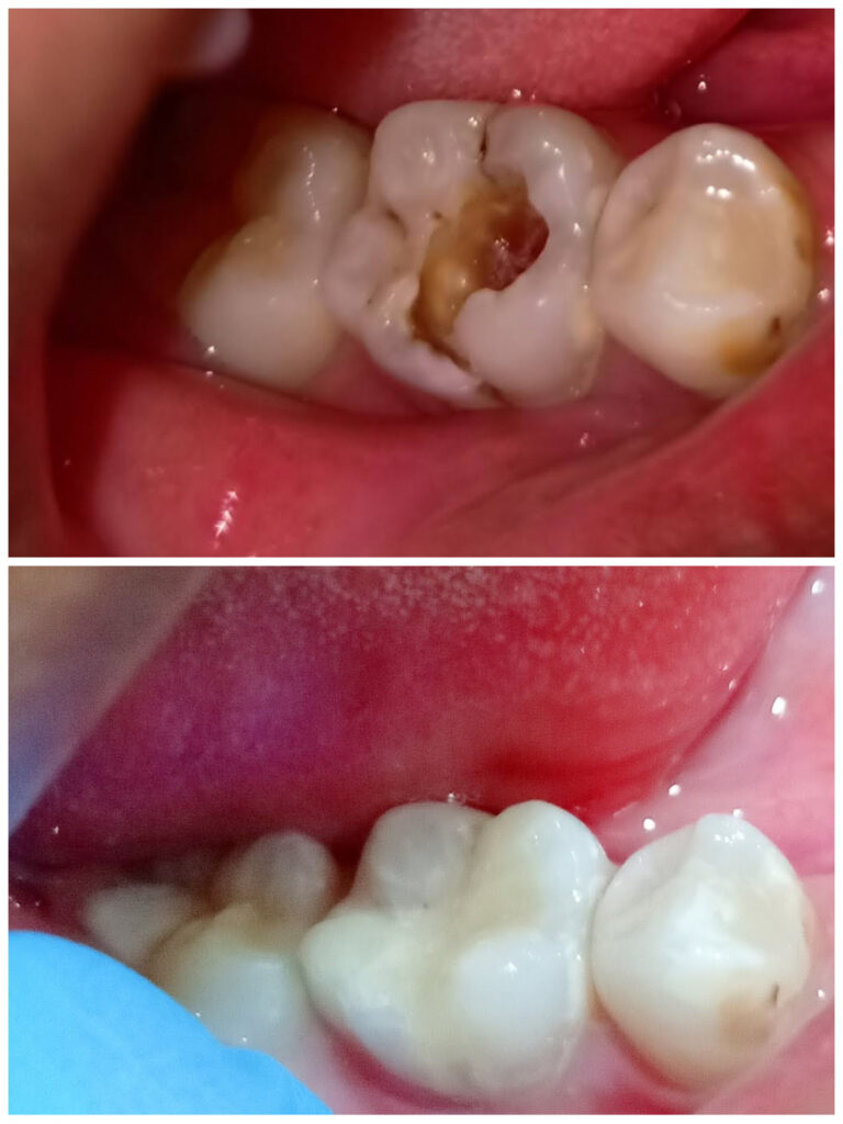 TOOTH RESTORATION